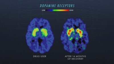 Adderall long term effects
